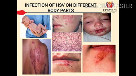 hsv infection